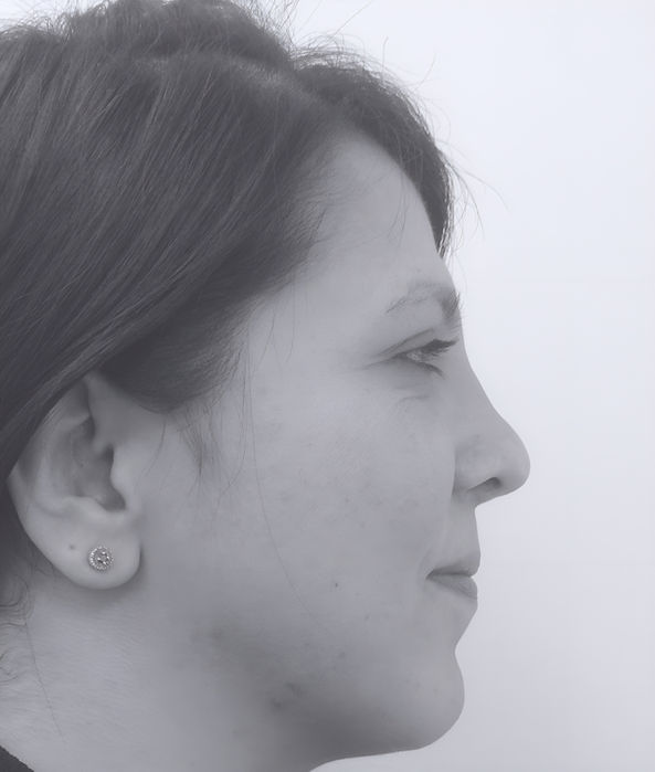 patient's nose after rhinoplasty in charlotte 