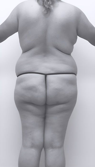 image of patient's body before lipoabdominoplasty in Charlotte