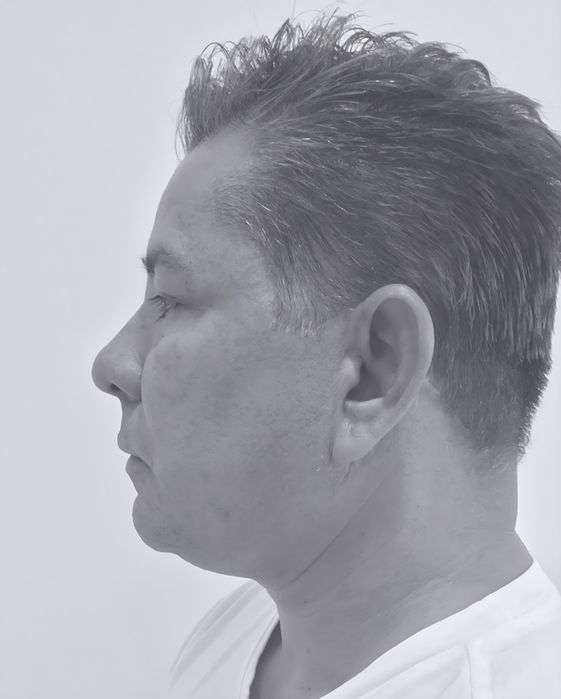 patient's face after face lift 