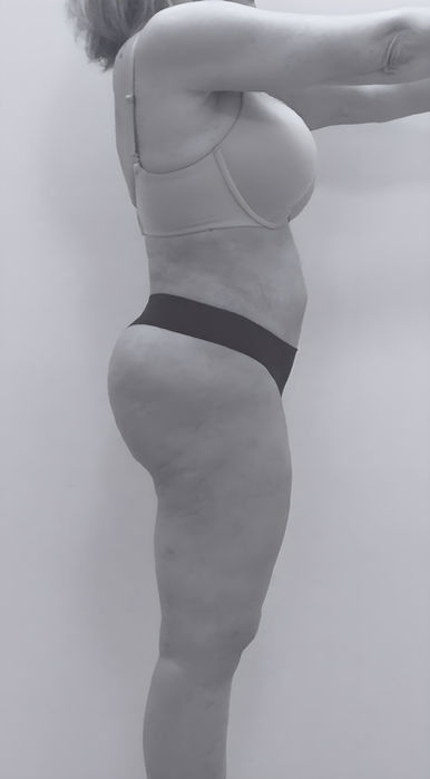 patient's body after liposuction in fort mill 