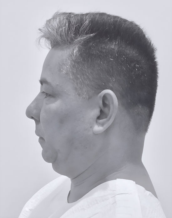 patient's face before face lift 