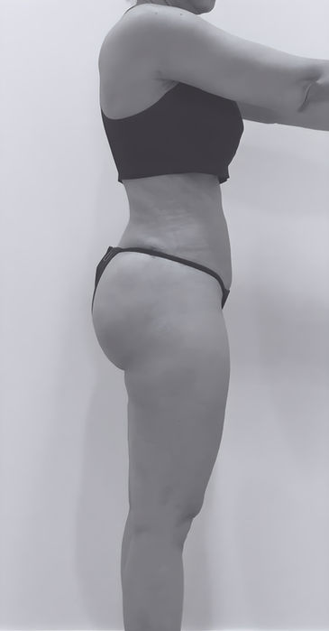 patient's body after liposuction in fort mill 