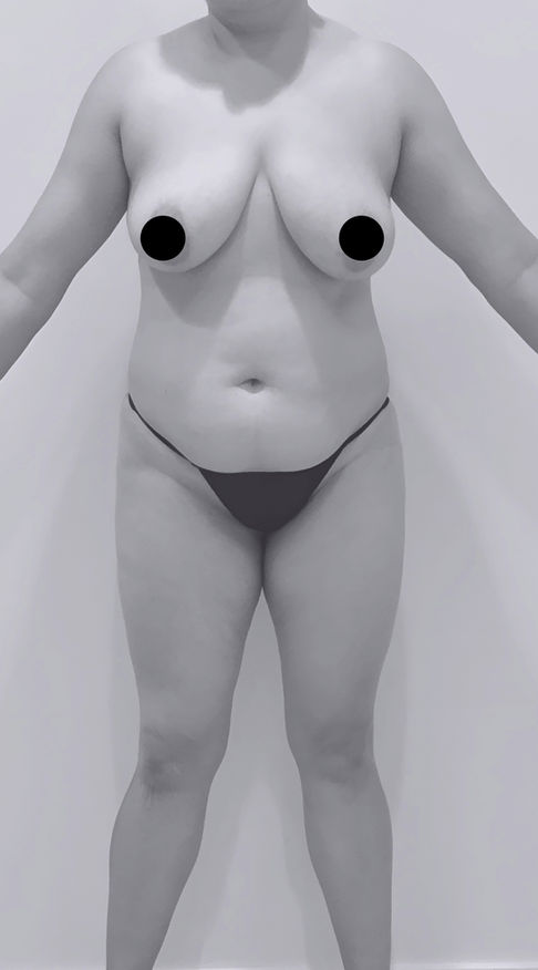 patient's body before BBL surgery in charlotte
