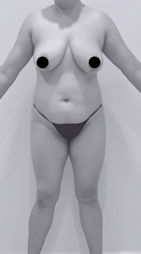 patient's body before BBL surgery in charlotte