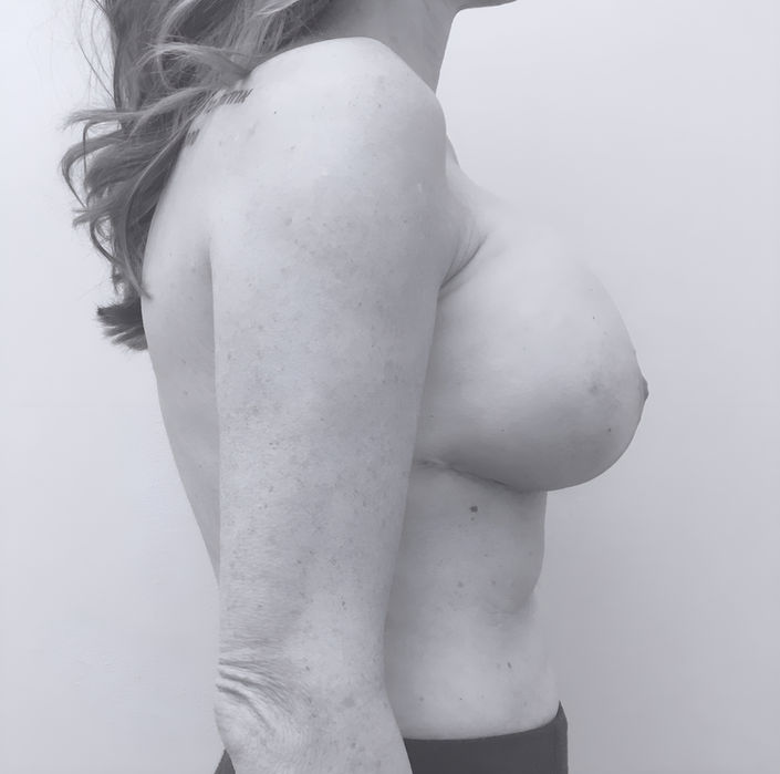 patient's breasts after breast lift in Charlotte