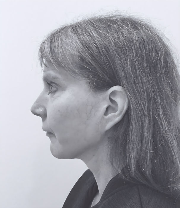 patient's face after face lift 