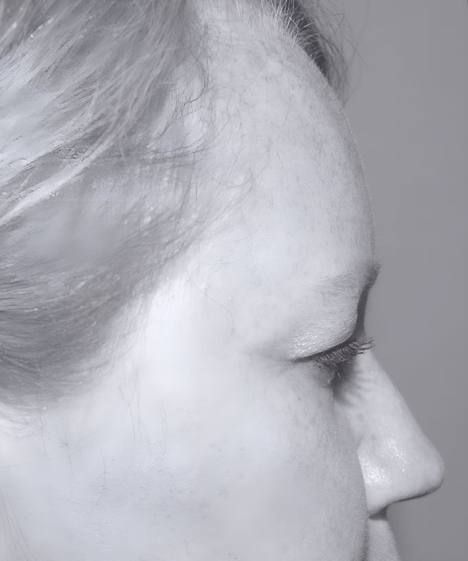 patient before Upper Brow and Eyelid Lift in charlotte
