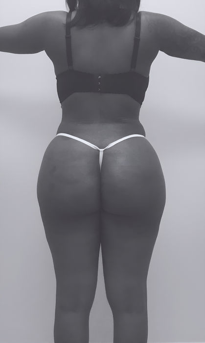 patient's butt after BBL surgery in charlotte
