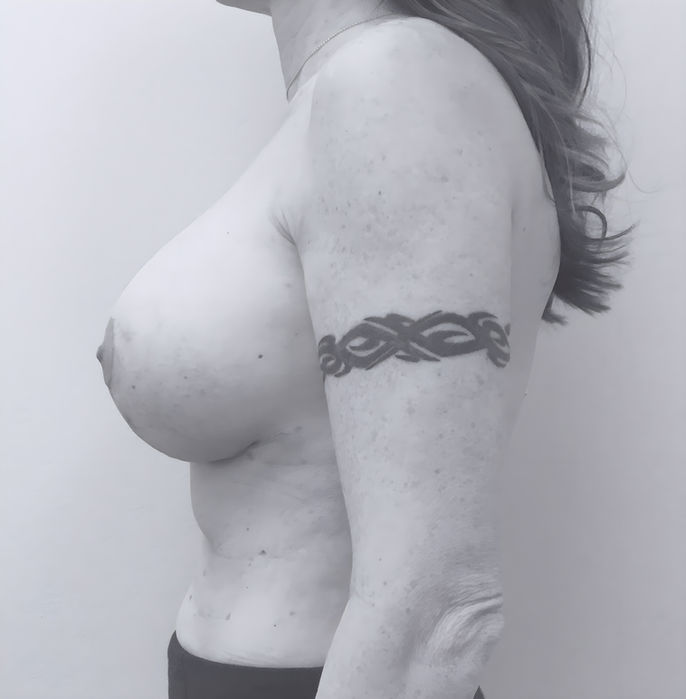 patient's breasts after breast lift in Charlotte
