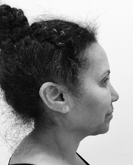 patient's face before face lift 