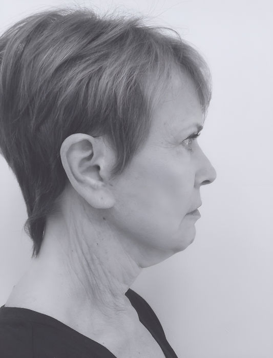 patient's face before face lift 