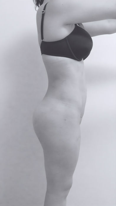 patient's body after liposuction in charlotte 