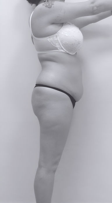 patient's side before BBL surgery in charlotte