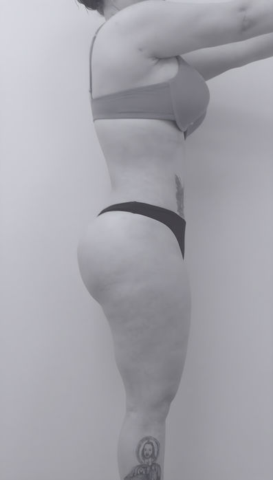 patient's body after revision abdominoplasty in charlotte