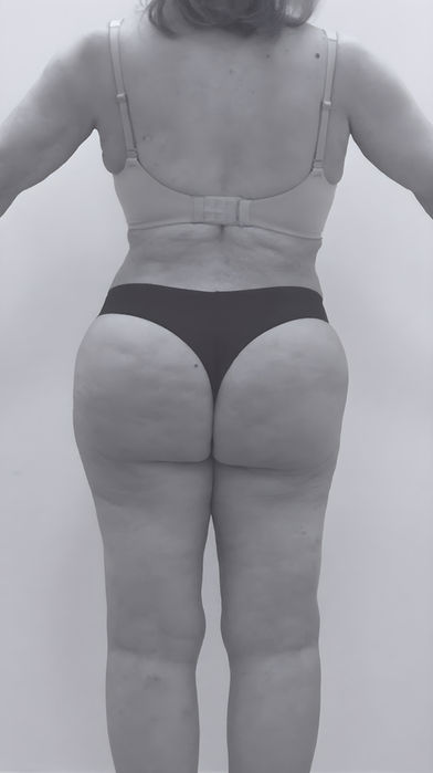 patient's body after liposuction in charlotte 