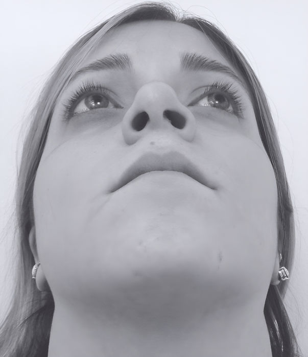 patient's nose after rhinoplasty in charlotte 