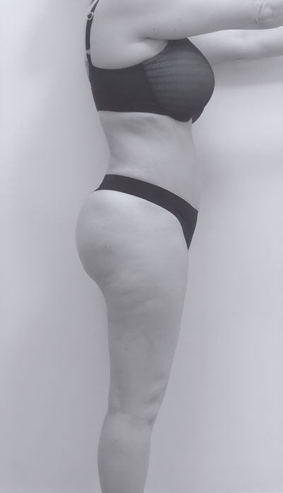 patient's side after BBL surgery in charlotte