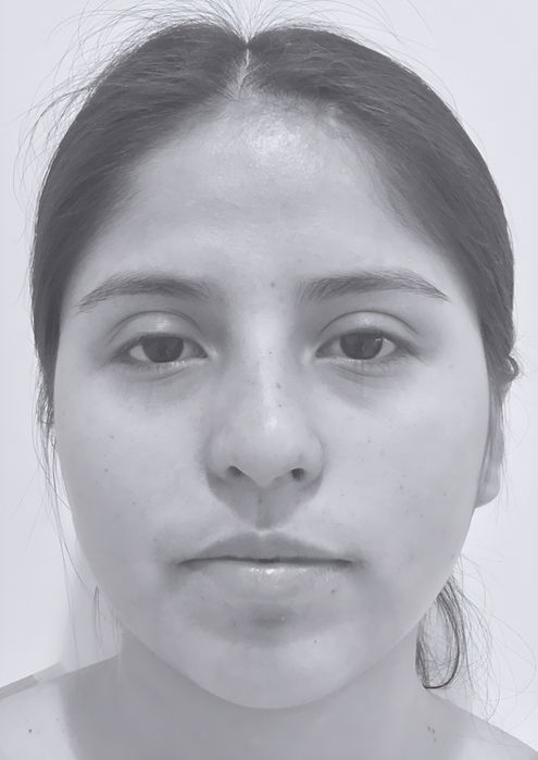 patient's nose before rhinoplasty in charlotte 