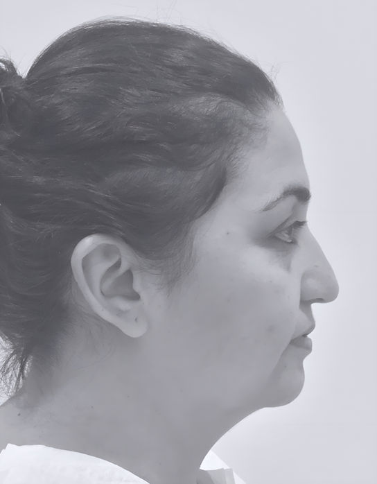 patient's nose before rhinoplasty in charlotte 