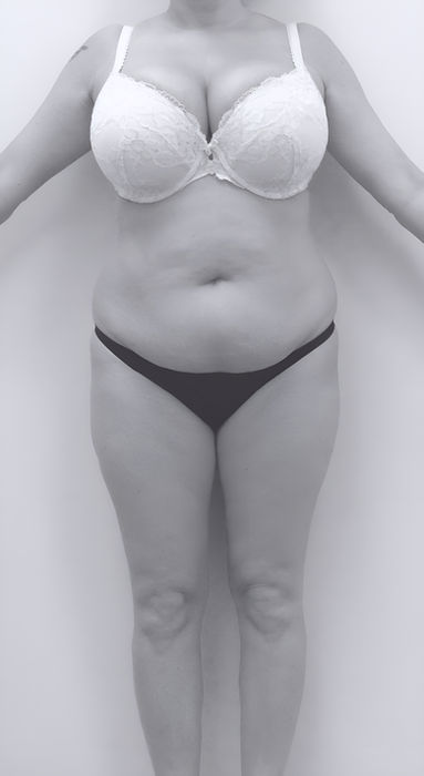 patient body before BBL surgery in charlotte