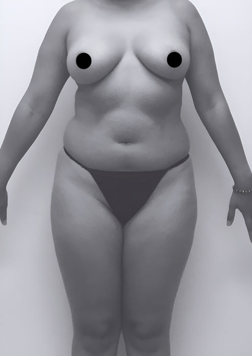 patient's body before BBL surgery in charlotte
