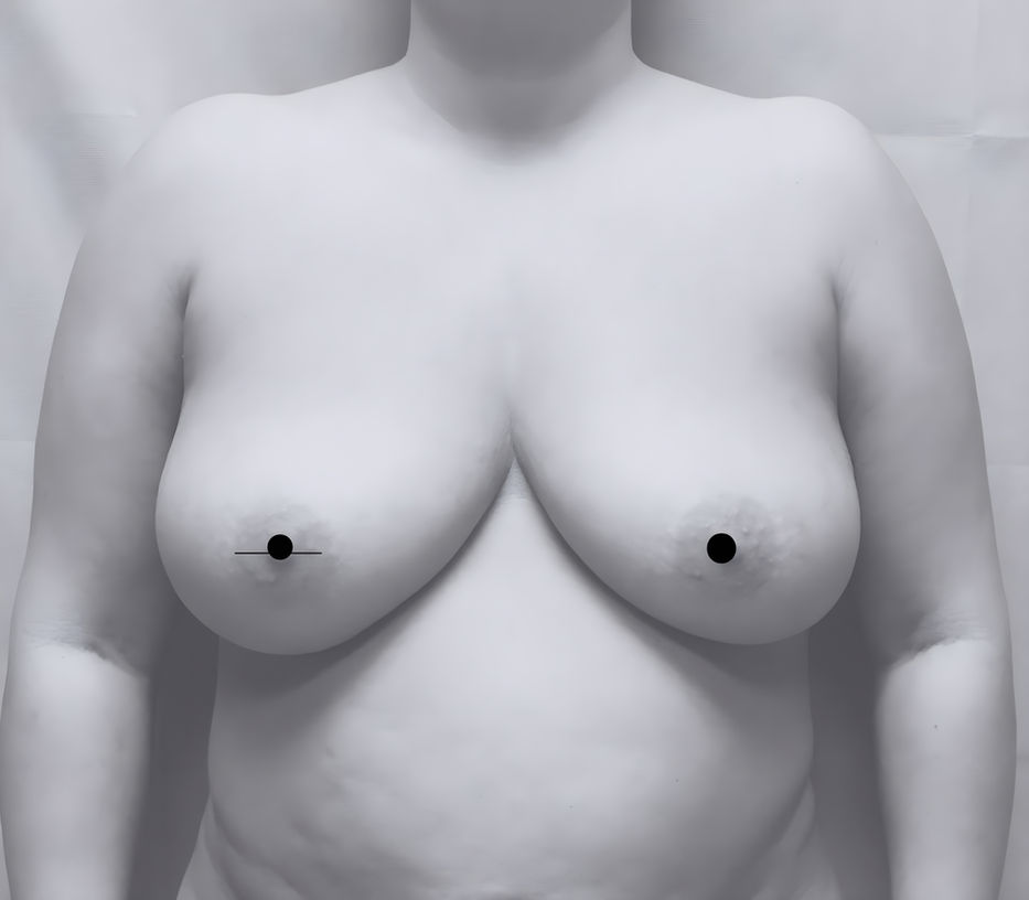 patient's breasts before breast reduction in Charlotte