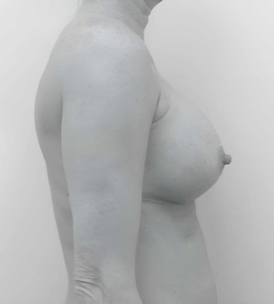 image of patient's breasts after breast augmentation in Charlotte