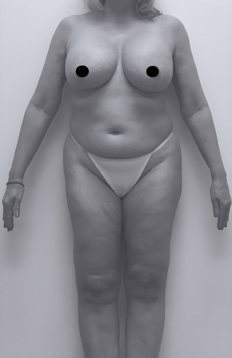 patient's body before liposuction in fort mill 