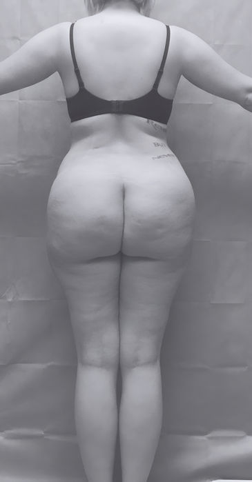patient's butt after BBL surgery in charlotte