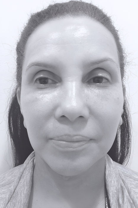 patient's face after face lift 