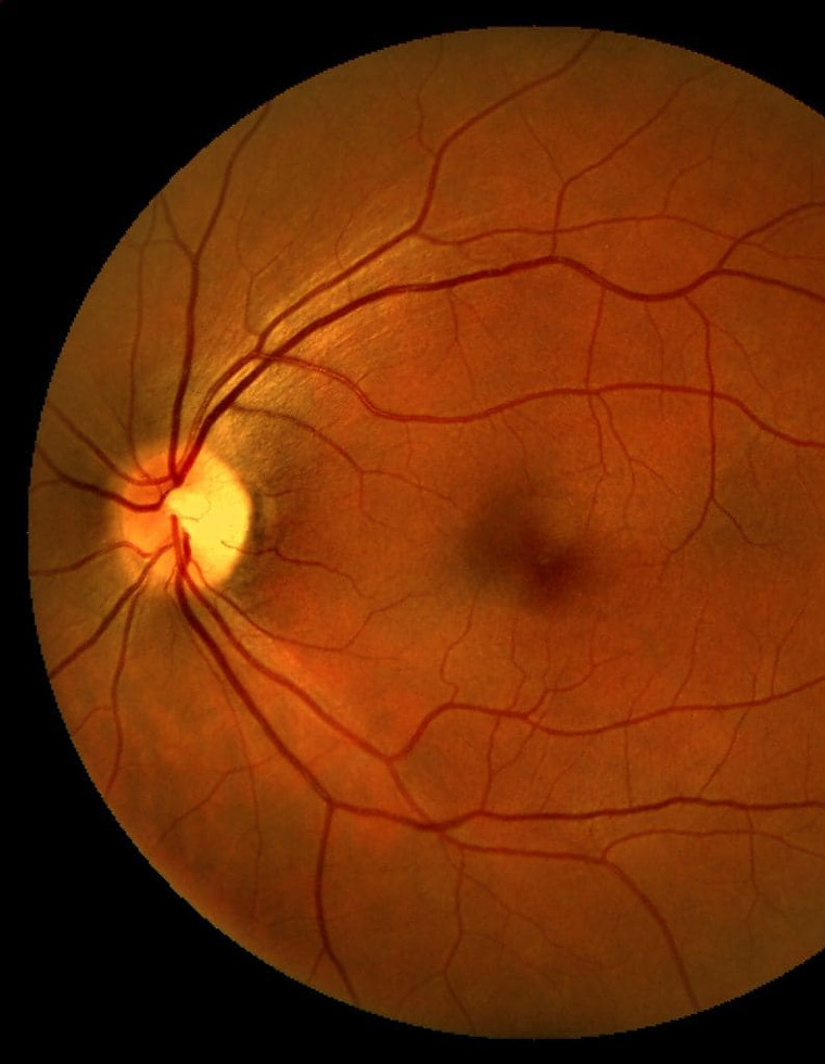 Imagem de fundo de olho humano obtida por retinografia, mostrando o disco óptico à esquerda, vasos sanguíneos retinianos e a mácula no centro.