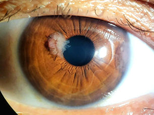 Ilustração sobre tumores oculares com biópsia ocular negativa, destacando etapas do exame, possíveis falhas e importância do patologista no diagnóstico.