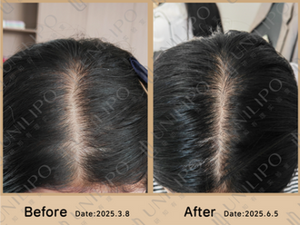 90 days, narrower part line! Alopecia areata is gone! How did we do it?