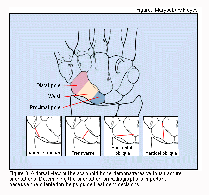 Scaphoid_fracture_types.gif