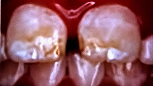 Mengenal Fluorosis:
Penyebab, Pencegahan, dan Pengobatan