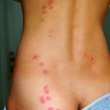 piqures de punaises de lit sur le dos 