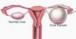 Yumurtalık Kanseri