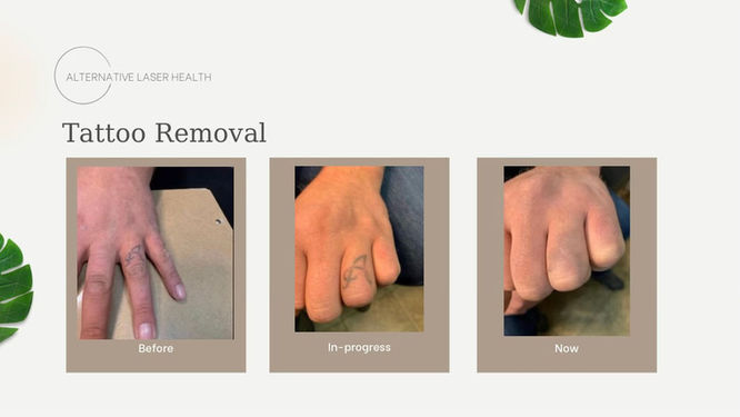 Alternative Laser Health’s Tattoo Removal image shows a small hand tattoo fading safely across three laser sessions, resulting in clear, natural skin using PicoSure® technology in Mississauga.