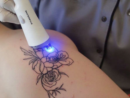 PicoWay laser tattoo removal treatment performed safely on different skin tones.