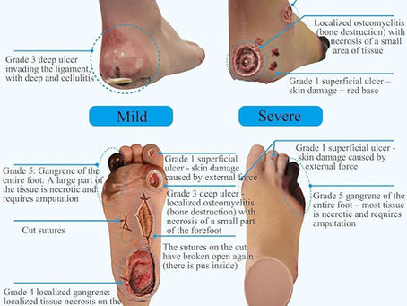 Medicazioni infermieristiche a domicilio a Catania e provincia per ferite, ferite chirurgiche, lesioni cutanee e lesioni da pressione.