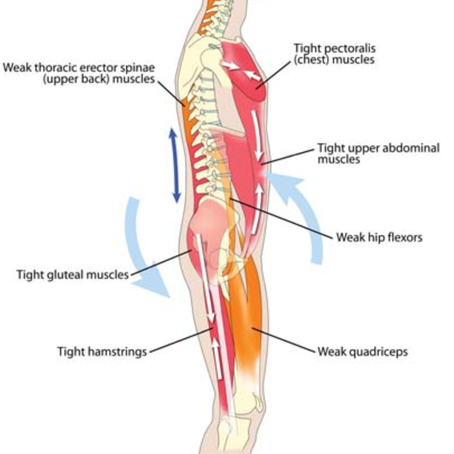One of the reasons your back pain isn't improving - Hamstrings