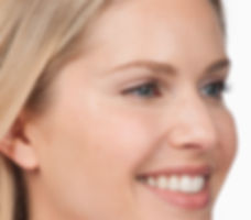 See the difference 7 days after Botox treatment for moderate to severe crow's feet