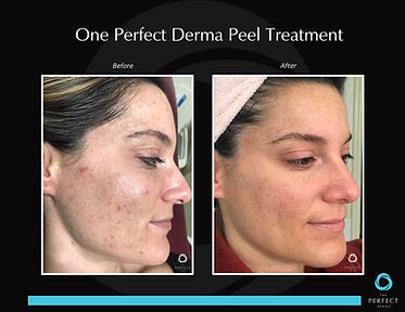 PD Acne.jpeg