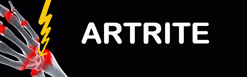 Artrite