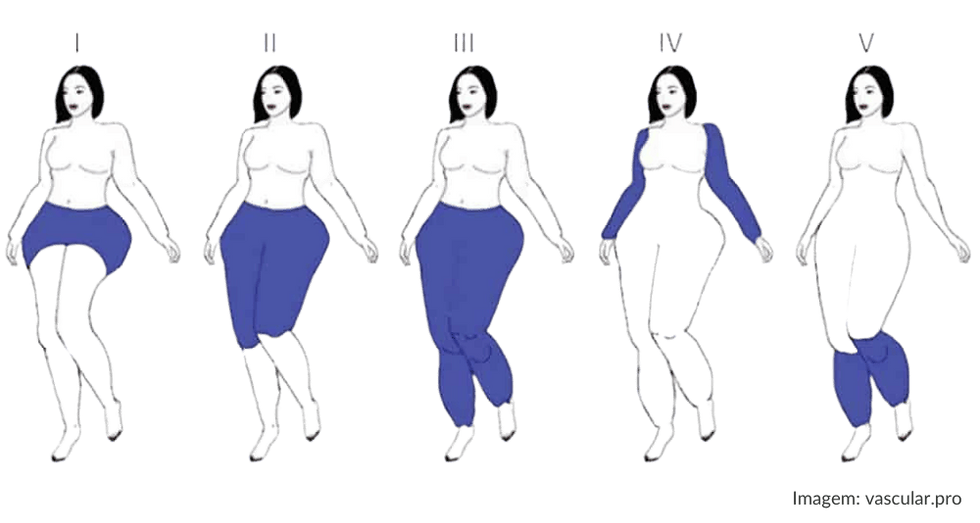 Ilustração mostrando os tipos de lipedema, de acordo com a área acometida