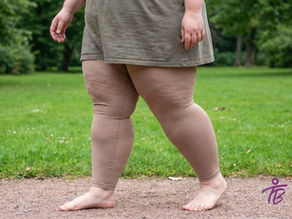 mulher com lipedema caminhando descalça em um parque