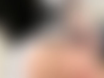 Photo of RF Microneedling treatment