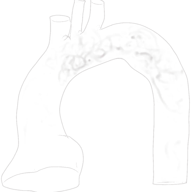 Blood flow visualization in Aortia