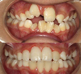 Braces Dehradun Uttarakhand