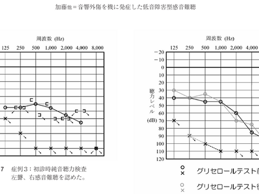 音響外傷を機に発症した低音障害型感音難聴